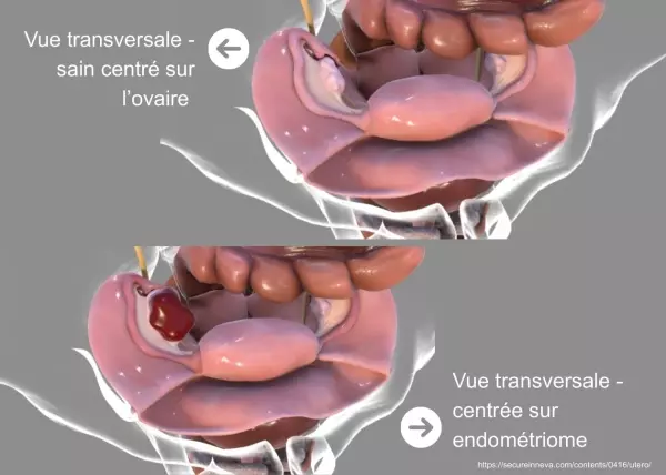 Définitions, localisation et épidémiologie