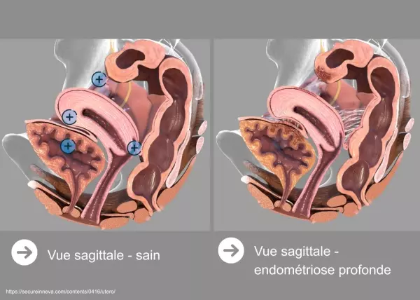 Définitions, localisation et épidémiologie