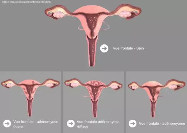 Définitions, localisation et épidémiologie