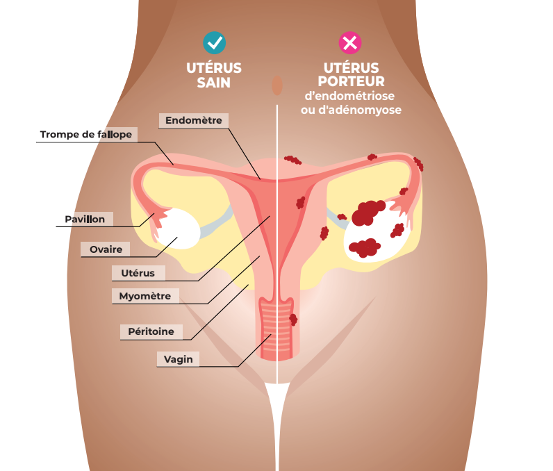 L’endométriose : Qu’est-ce que c’est ? 