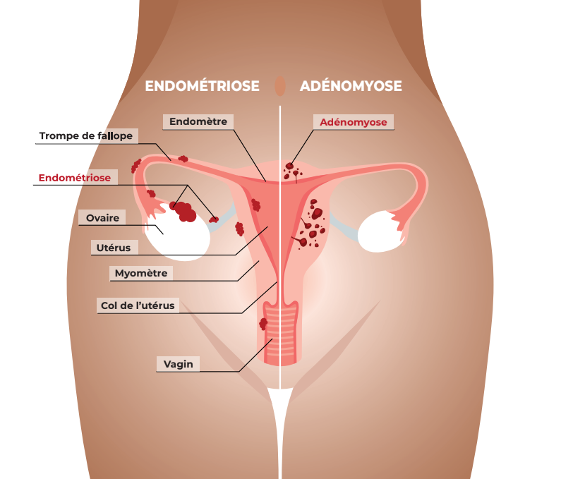 L’endométriose : Qu’est-ce que c’est ? 
